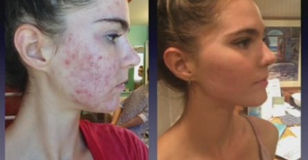 IMALE SU UŽASAN PROBLEM SA AKNAMA,  USPJELE SU DA IH SE RIJEŠE ZA SAMO 3 DANA: Ovo je njihova tajna