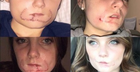 RASKINULA SAM SA DEČKOM I NASTAO JE HOROR KAD JE VIKNUO: Ostaviću ti TRAG NA LICU za sljedećeg dečka, od tada izgledam kao ČUDOVIŠTE! (FOTO)
