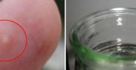 KAKO OVO RANIJE NISMO ZNALI: Evo kako da izvadite trn koristeći samo bocu!