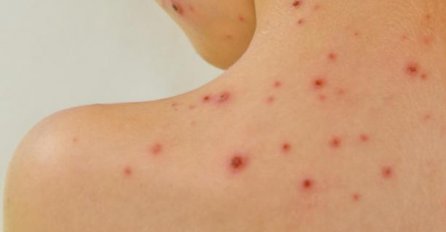 Političar koji se protivi cijepljenju obolio od vodenih kozica