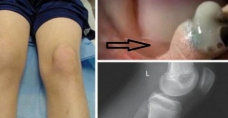 ODLUČILA JE DA SAMA ISTISNE RANU NA KOLJENU SVOG SINA: Kad je ovo izašlo, POČELA JE DA VRIŠTI! (FOTO)