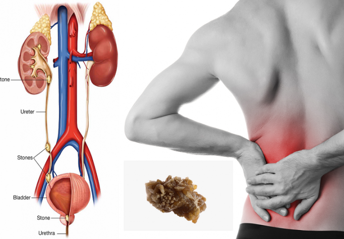 RECEPT OD SAMO DVA SASTOJKA KOJEG SVI DIJELE: Očistite vaš bubrege i gledajte kako bubrežni kamenci izlaze! 