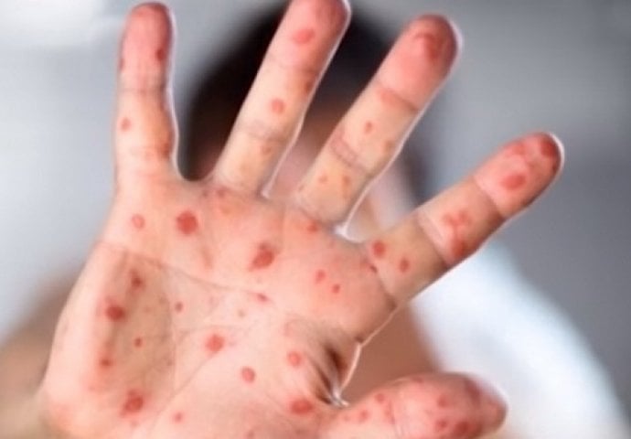 Proglašena epidemija morbila u Banjoj Luci