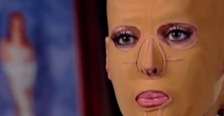 LJUBOMORNA ŽENA JE ŽIVU SPALILA: Nosila masku 3 godine, imala 200 operacija, a EVO KAKO DANAS IZGLEDA!