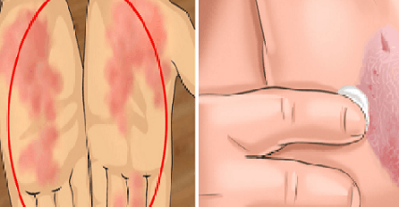KONAČNO OTKRILI: Ovo je prijeki lijek za sva kožna oboljenja, pa i PSORIJAZU 