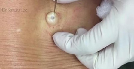 GODINAMA JE IMALA ČUDNU KVRŽICU NA LEĐIMA: Kad je doktorica napravila REZ, IZAŠLO JE NEŠTO ŠTO NIKO NIJE OČEKIVAO! (VIDEO)