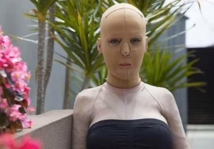 SRPKINJU ŽIVU SPALILA LJUBOMORNA ŽENA: Nosila masku 3 godine, imala 200 operacija, a evo kako danas izgleda  