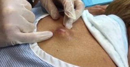 NA LEĐIMA JOJ SE POJAVILA OGROMNA BUBULJICA: Otišla je doktoru, a kad su vidjeli šta je IZAŠLO NIJE IM BILO DOBRO (FOTO)