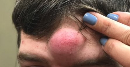 DŽINOVSKA BUBULJICA MU JE RASLA NA ČELU, ZVALI SU GA JEDNOROG: Otišao je u bolnicu, A KAD SU VIDJELI ŠTA JE IZAŠLO IZ NJE, DOŠLO IM ZLO (VIDEO)