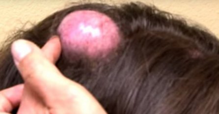 DVADESET GODINA JE NA GLAVI IMALA OVO "JAJE", MISLILA JE DA NIJE NIŠTA OPASNO: Kad je otišla kod doktora, OSTALI SU U ŠOKU KAD JE OVO IZAŠLO! (VIDEO)