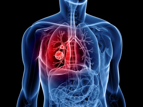 lung-cancer