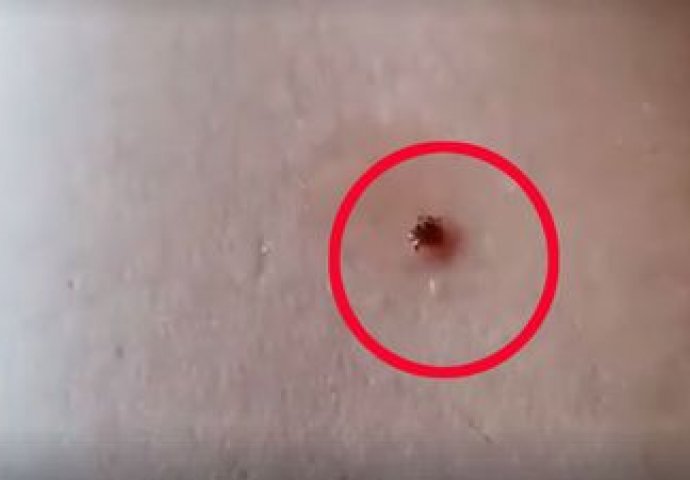 NAKAPALA JE OVO ULJE NA KOŽU I KRPELJ JE SAM ISKOČIO: Ovo je najučinkovitije sredstvo protiv malih napasti