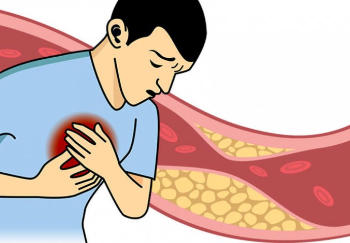 OVU PROMJENU NA TIJELU NIKAKO NE SMIJETE DA IGNORIŠETE: Ovo može biti najraniji simptom povišenog holesterola!