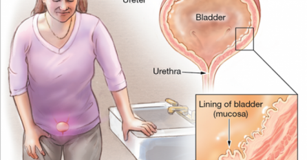 Ako imate upalu mokraćnog mjehura: Evo kako da je izliječite  prirodnim putem!