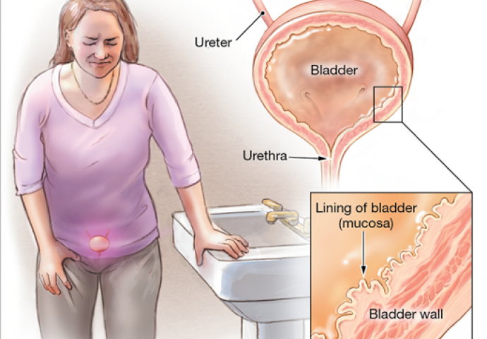 Ako imate upalu mokraćnog mjehura: Evo kako da je izliječite  prirodnim putem!
