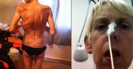 Nekada je imala preko 135 kilograma: Žena s viškom kilograma se pretvorila u kost i kožu, sada se bori za život