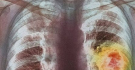 NJEMAČKI NOBELOVAC ZAPREPASTIO SVIJET: Rak se dobija od ove DVIJE NAMIRNICE, da su znali ljudi još bi bili živi