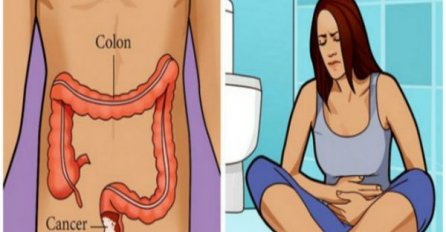 Rak debelog crijeva izlječiv je u 9 od 10 slučajeva: SVI MORAJU ZNATI OVIH 6 SIMPTOMA KOJI SE PRVI JAVLJAJU
