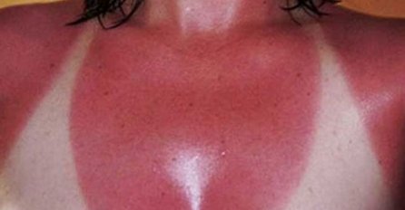 JOGURT NE POMAŽE: OVA MAJKA OTKRILA JE TRIK GODINE: Samo na ovaj način opekotine od sunca će nestati za POLA SATA 