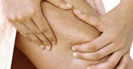 NIJEDNA ŽENA NE ŽELI OVAKO DA IZGLEDA, zaboravite na skupe preparate protiv celulita: Rješenje se krije u jeftinoj flašici i kažu da daje SJAJNE REZULTATE