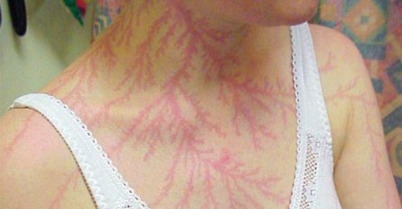 ONI SU PREŽIVJELI UDAR GROMA, A OVAKO SADA IZGLEDAJU NJIHOVA TIJELA: Kad vidite sliku broj 3. PITAT ĆETE SE KAKO JE OVO MOGUĆE!