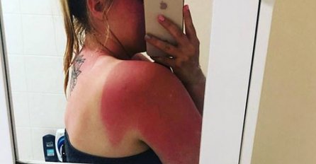 NE POMAŽE NI JOGURT, LJUDI NA INTERNETU MASOVNO OBJAVLJUJU SLIKE GROZNIH OPEKOTINA OD SUNCA: Ovo boli i preko ekrana!