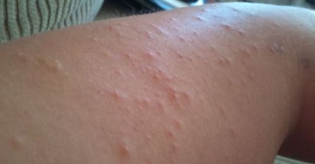 KOMARCI VAM PRAVE PAKAO OD ŽIVOTA? Samo isijecite OVO VOĆE na pola i ostavite u sobi, VIŠE IH NIKADA NEĆETE VIDJETI BLIZU!