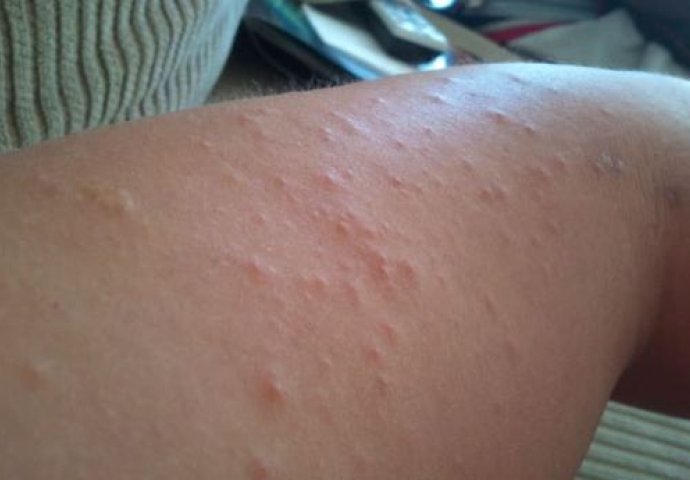 Komarci su mi prije dvije godine uništili ljeto i ovako je izgledalo: Kada sam naučila ovaj trik NIJEDAN ME VIŠE NIJE UGRIZAO 