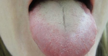 DA LI IMATE OVE BIJELE NASLAGE NA JEZIKU? Doktori upozoravaju, ovo je simptom OPASNOG STANJA KOJE POGAĐA I MUŠKARCE I ŽENE!