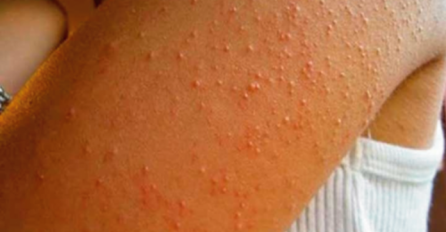 IMATE LI OVE BUBULJICE NA RUCI? Evo zašto se pojavljuju, ovo morate znati!