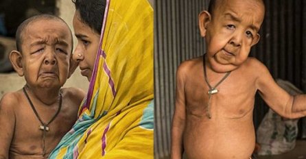 DA SRCE PREPUKNE : Dječak (7) pati od rijetke bolesti zbog koje izgleda kao starac