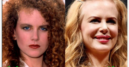 Nikol Kidman NEPREPOZNATLJIVA! Kad vidite šta su joj uradili od lica uhvatiti ćete se za glavu! Ubrizgavala mast  OVIH kokoši u lice pa joj sad LICE POTPUNO DEFORMISANO