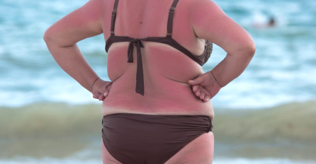 JOGURT VAM NEĆE POMOĆI, OVA MAJKA JE OTKRILA TRIK GODINE: Samo na ovaj način opekotine od sunca će nestati za POLA SATA 