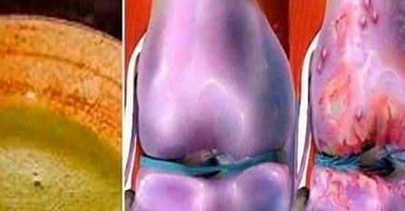 ZALUDIO SVIJET I UŠUTKAO DOKTORE: Ovaj napitak liječi bolna koljena i regeneriše kosti i zglobove odmah!