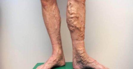 OVAJ RUSKI RECEPT RASTVARA TROMB: Spas za proširene i upaljene vene! SAD KONAČNO MOGU BEZ STIDA NA PLAŽU