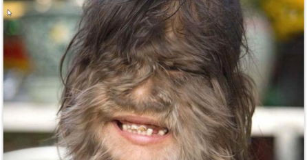 Djeca se pretvorila u vukodlake zbog OVIH lijekova koje su im doktori propisivali! 