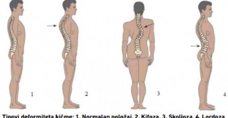Doktori zabrinuti: Sve izraženiji deformiteti lokomotornog sistema kod školaraca