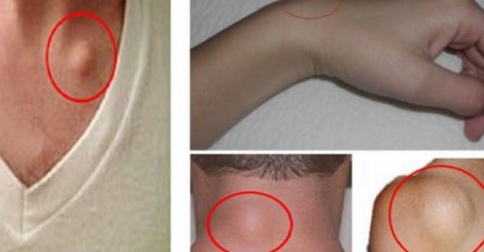 Imate li ovakve izrasline? Evo kako da ih se riješite PREKO NOĆI, bez odlaska doktoru i OPERACIJE!