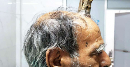 SVIJET U ŠOKU, NIKO NE VJERUJE ŠTA VIDI! Ovom čovjeku je izrastao ĐAVOLJI ROG NA SREDINI GLAVE! Ove slike će vam se urezati u pamćenje, NIŠTA ČUDNIJE NE POSTOJI!