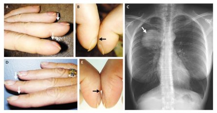 UKOLIKO OVO VIDITE NA PRSTU, PRIJETI VAM SMRTONOSNA BOLEST PLUĆA: Odmah pogledaJte u svoje prste!