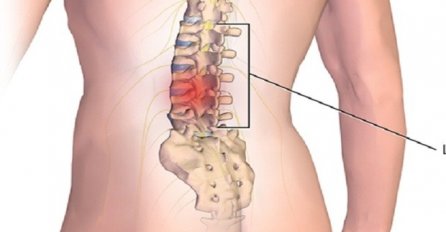 DISKUS HERNIJA ODLAZI I NE VRAĆA SE: Ovaj DOMAĆI LIJEK potpuno obnavlja kičmu, jača je i liječi, brzo zapišite RECEPT