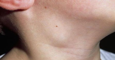 NIJE PROLAZNO: Zašto su vam LIMFNI čvorovi NATEČENI? Razlog je mnogo OPASNIJI nego što ste mislili!