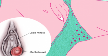 PROŠLA SAM PAKAO "TAMO DOLJE" ZBOG BARTOLINIJEVE ŽLIJEZDE: Ovo svaka žena treba da pročita!