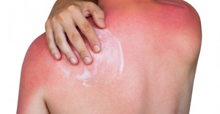 JOGURT NE POMAŽE! OVA MAJKA OTKRILA JE TRIK GODINE: Samo na ovaj način opekotine od sunca će nestati za POLA SATA 