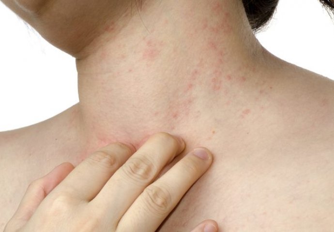 MNOGI ZANEMARE SVRAB, ALI MOŽE BITI SIMPTOM OPASNE BOLESTI: Ovo je 10 razloga zbog čega koža može da svrbi