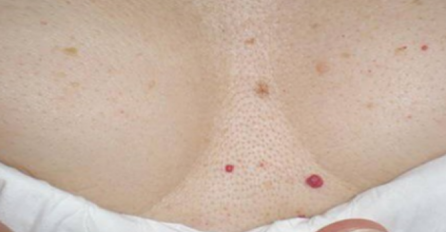 ODMAH POGLEDAJTE, OVO SVI TREBAJU ZNATI: Ako imate ove crvene tačkice po tijelu, evo šta trebate raditi!
