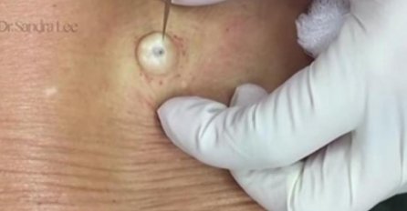 GODINAMA JE IMALA ČUDNU KVRŽICU NA LEĐIMA: Kad je doktorica napravila REZ, IZAŠLO JE NEŠTO ŠTO NIKO NIJE OČEKIVAO! (VIDEO)