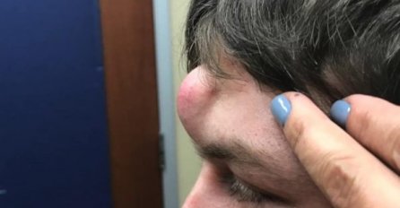 DŽINOVSKA BUBULJICA MU JE RASLA NA ČELU, ZVALI SU GA JEDNOROG: Otišao je u bolnicu, A KAD SU VIDJELI ŠTA JE IZAŠLO IZ NJE, DOŠLO IM ZLO