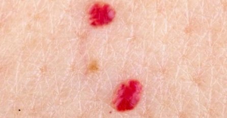 OPREZ! IMATE LI OVE CRVENE TAČKICE NA TIJELU?! To nisu popucali kapilari, EVO O ČEMU JE ZAISTA RIJEČ! 