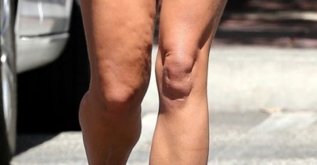 CELULIT NA SVE STRANE, A SALO KIPI: Za nju kažu da je najzgodnija žena, ali čekajte DA JE VIDITE IZBLIZA! (FOTO)